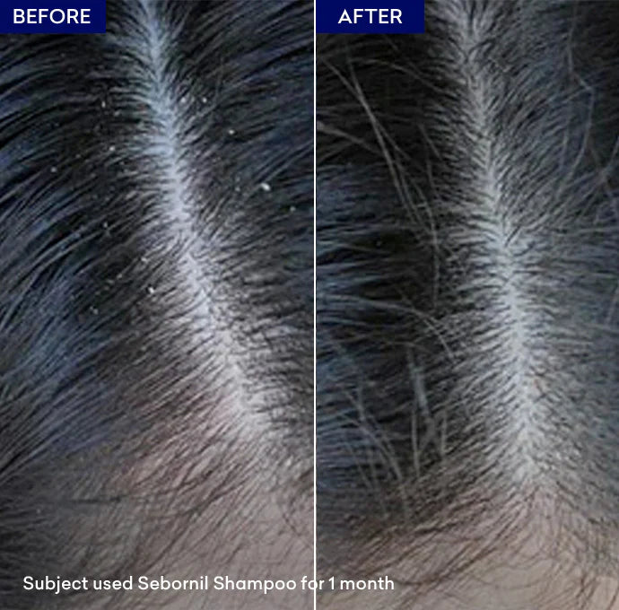 Jenpharm Sebornil Anti Dandruff Shampoo