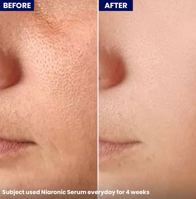 Jenpharm Niaronic Acne Control Serum (Pore Minimizing)