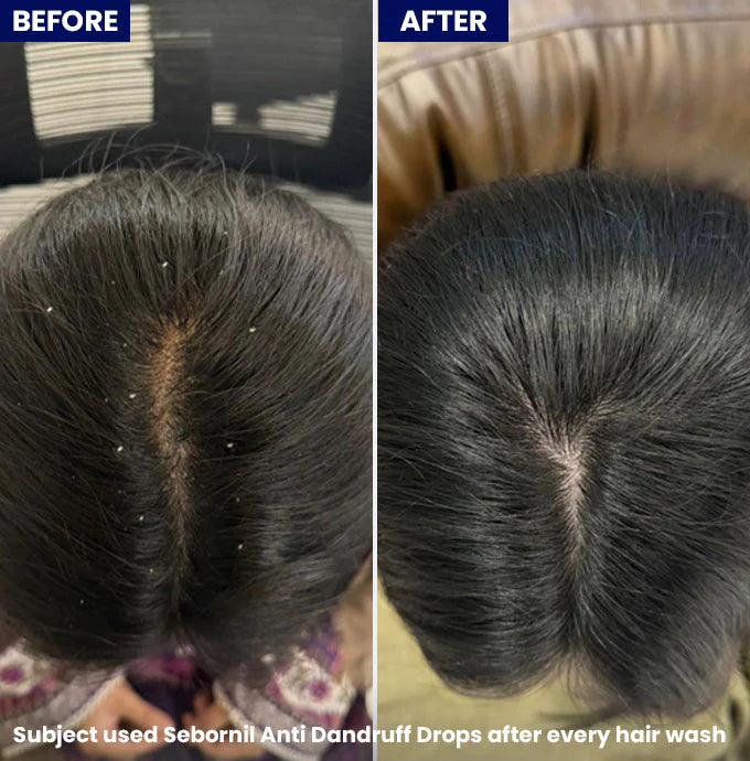 Jenpharm Sebornil Anti Dandruff Drops