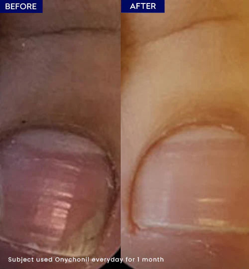 Jenpharm Onychonil Nail Paint