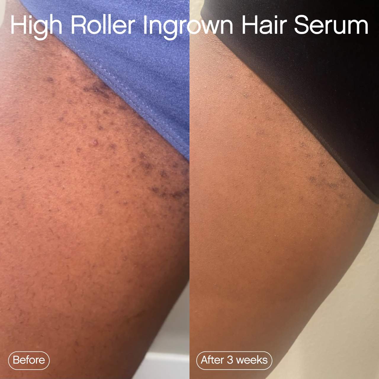 Topicals High Roller Ingrown Tonic Lotion