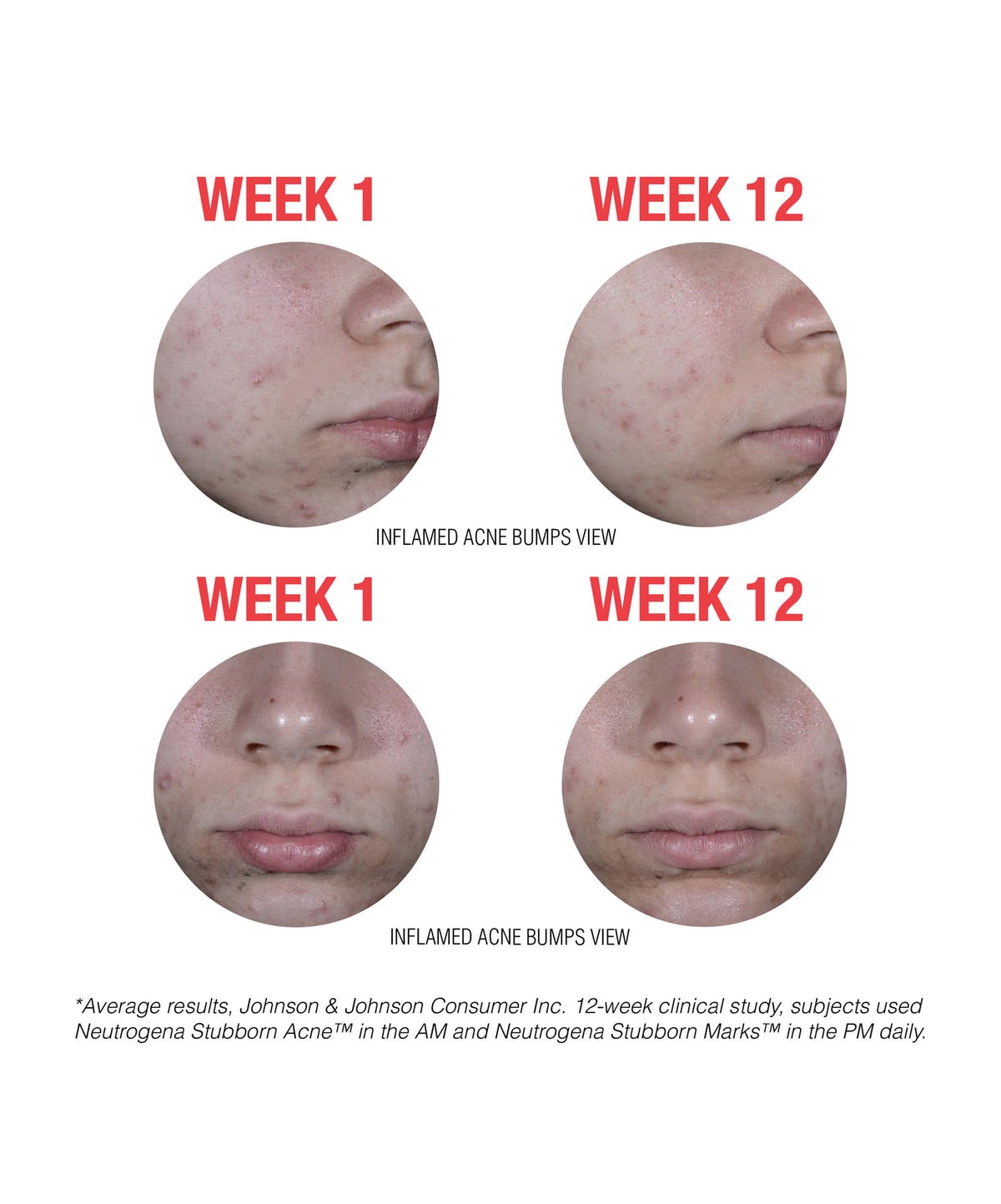 Neutrogena Stubborn Acne AM Treatment