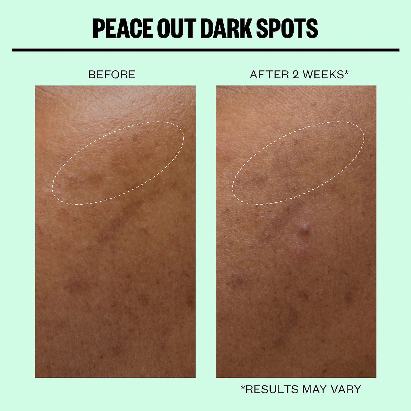 Peace Out Microneedling Dark Spot Brightening Dots