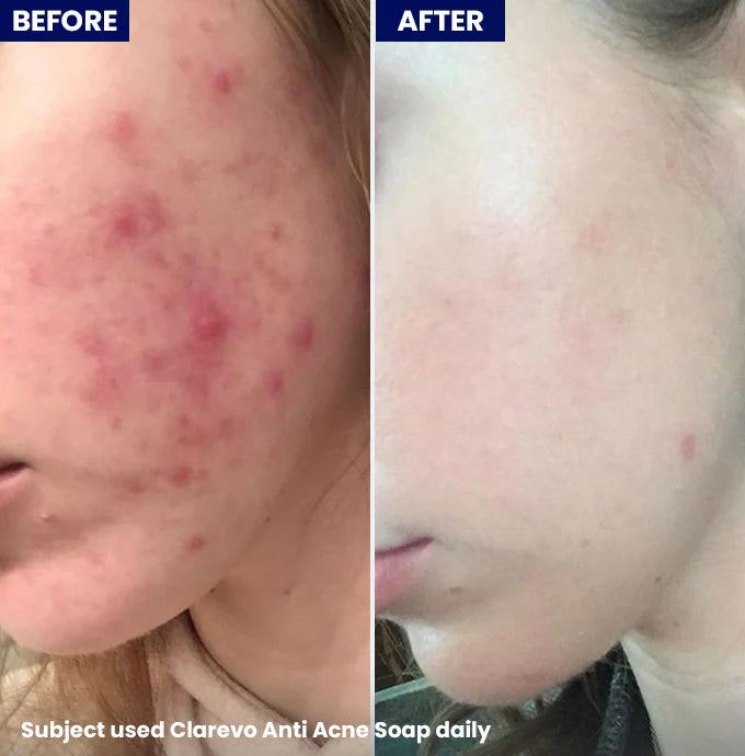 Jenpharm Clarevo Anti Acne Soap