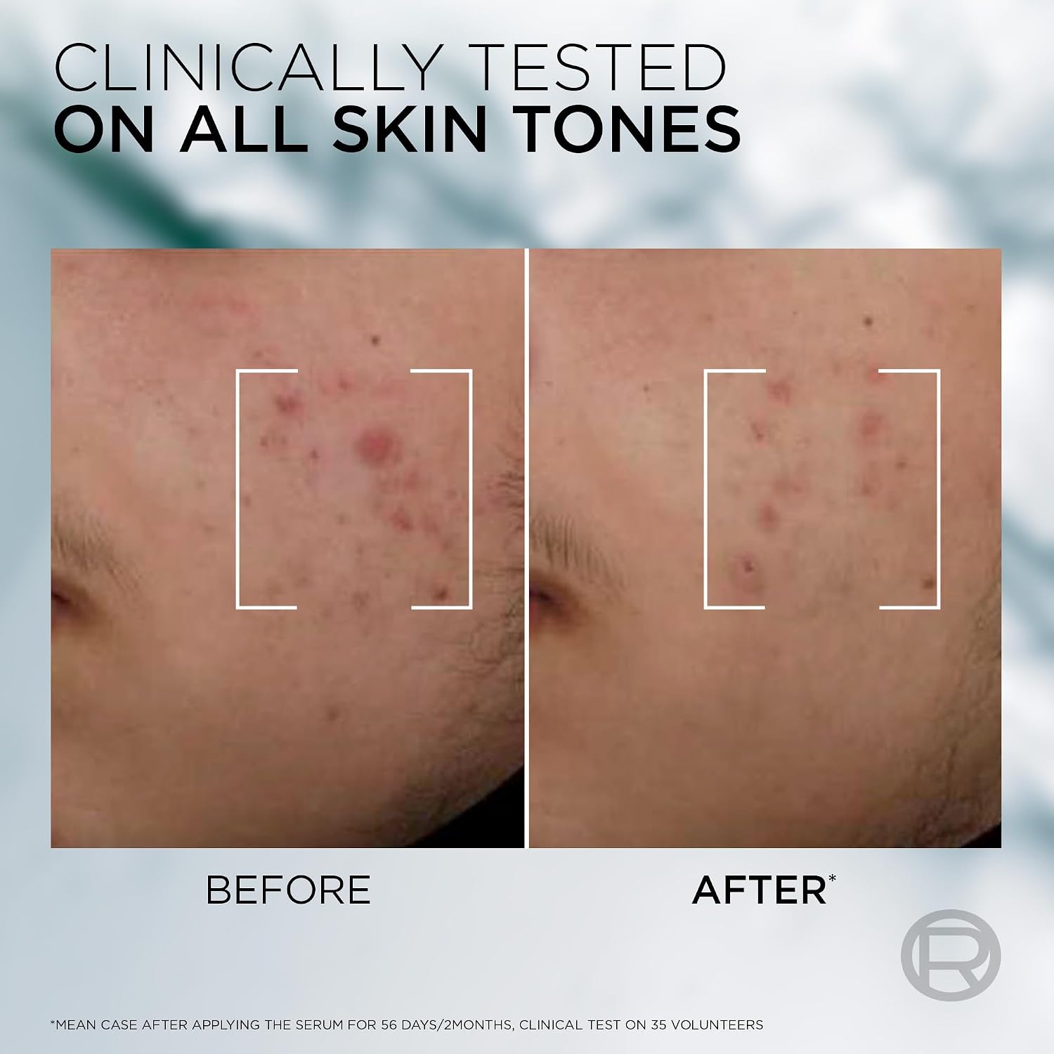 L'Oreal Men Expert Derma Control Anti-Blemish Serum
