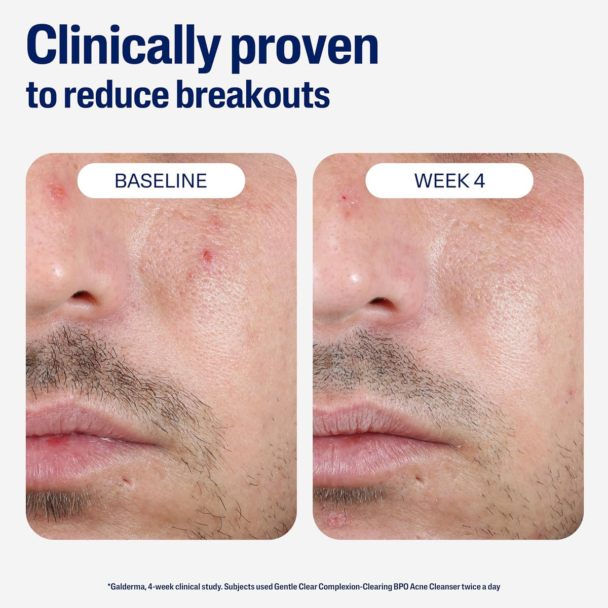 Cetaphil Acne Gentle Clear Complexion Clearing Acne Cleanser