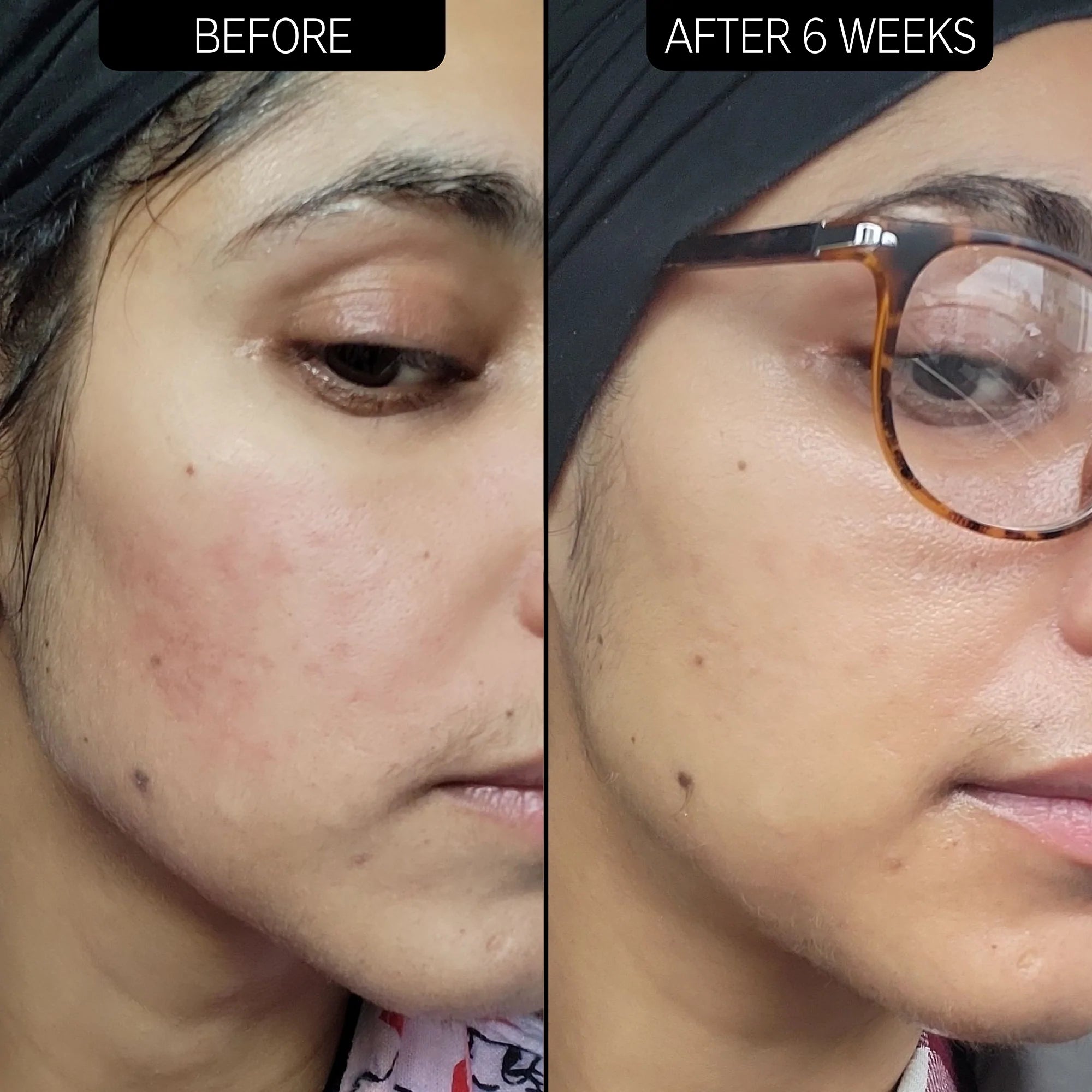The Inkey List Redness Relief 10% Azelaic Acid Serum