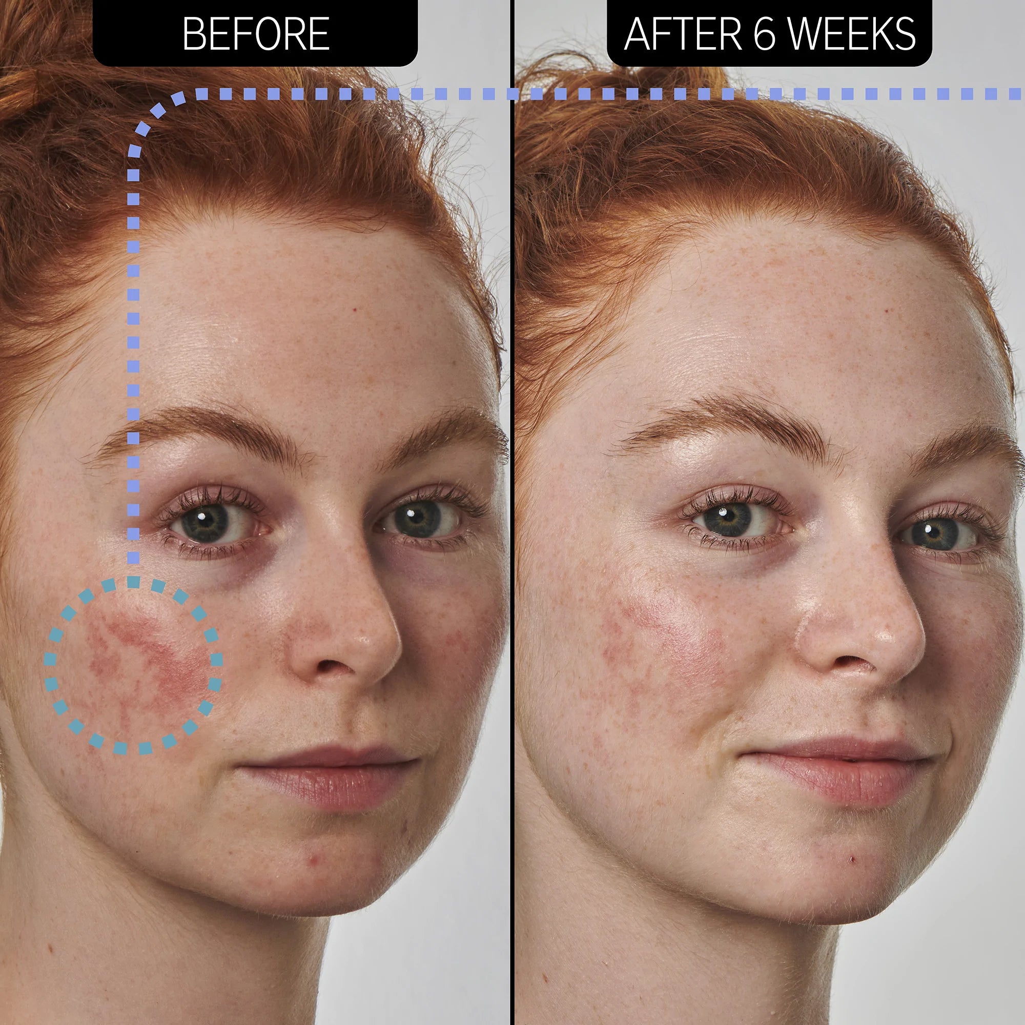 The Inkey List Redness Relief 10% Azelaic Acid Serum