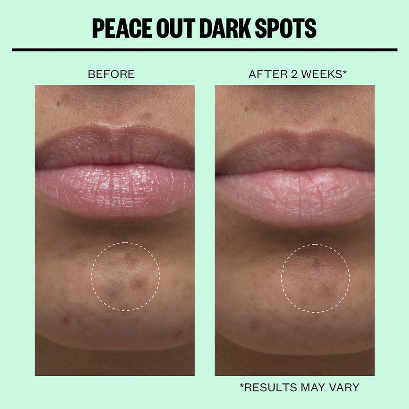 Peace Out Microneedling Dark Spot Brightening Dots