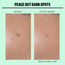 Peace Out Microneedling Dark Spot Brightening Dots